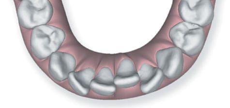 Underbite image