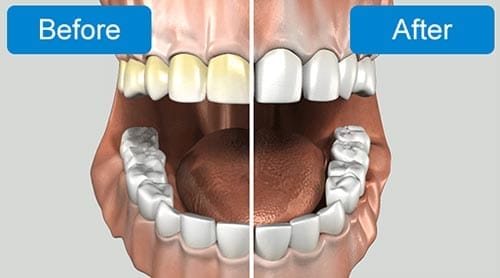 A before and after of teeth whitening