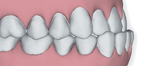 Underbite image