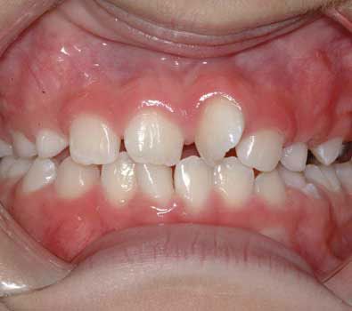 Crooked teeth